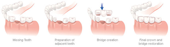 image Of Dental Crowns and Bridges