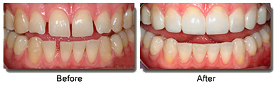 Before And After image, Dentist Sacramento