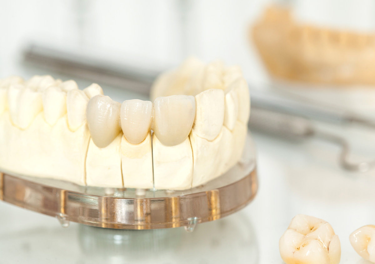 Crowns for tooth restoration in Sacramento