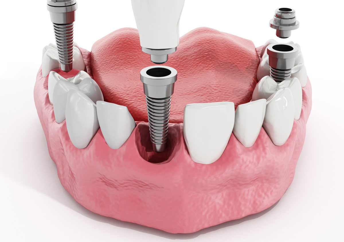 Comprehensive dental implants services in Sacramento, CA