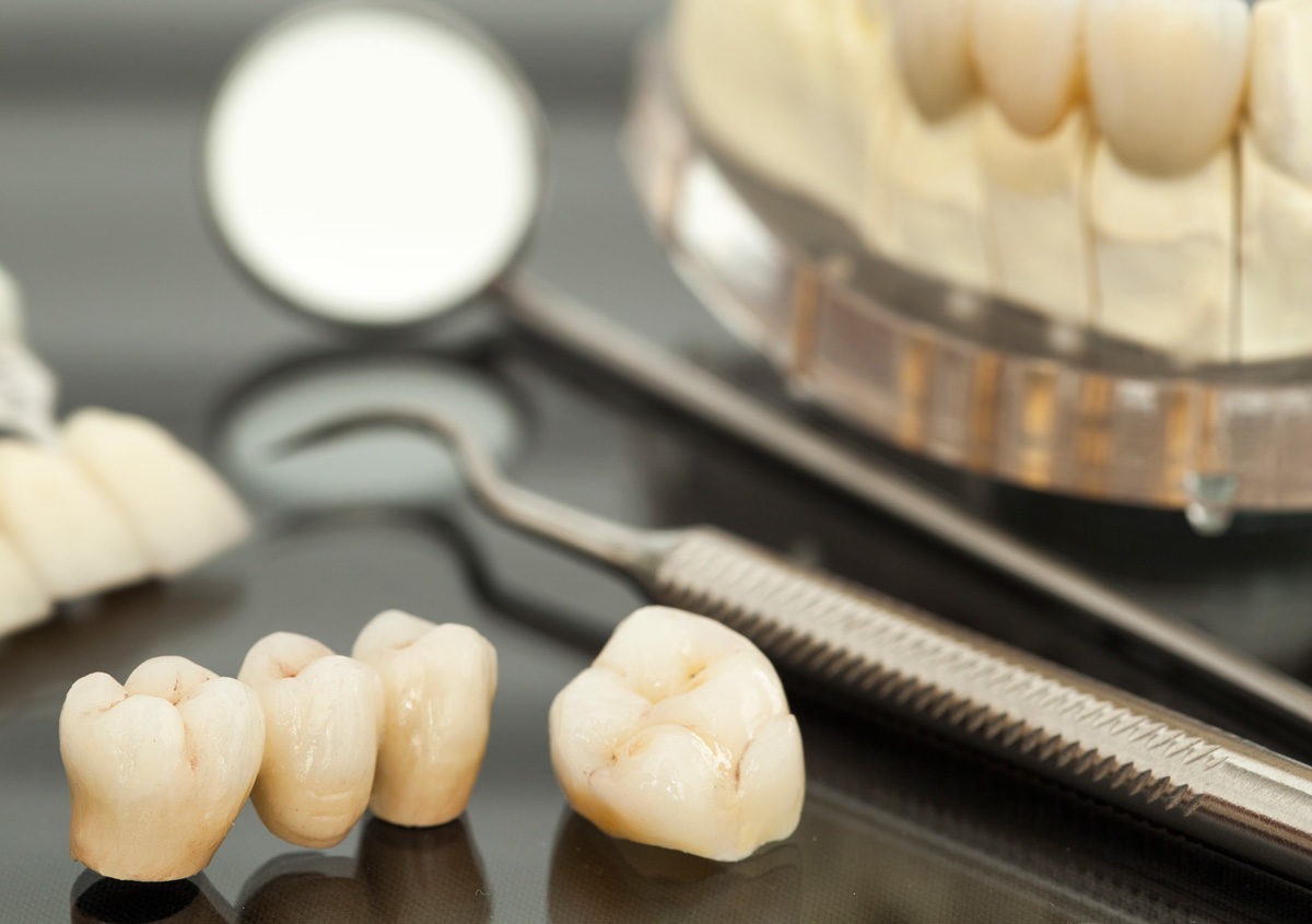 Dentist explains when a dental bridge is a good choice for Sacramento patients