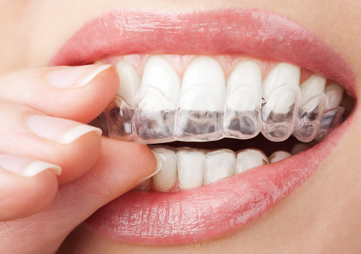 Sacramento area practice offers removable braces for treatment of malocclusion