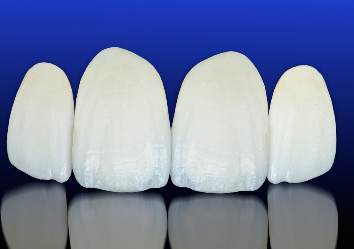 Sacramento dentists beautifully repair a tooth with a porcelain crown
