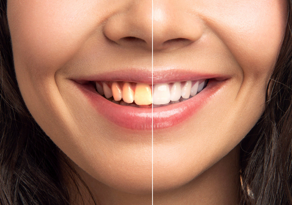 Dentist in Sacramento, CA answers, what is professional teeth whitening?
