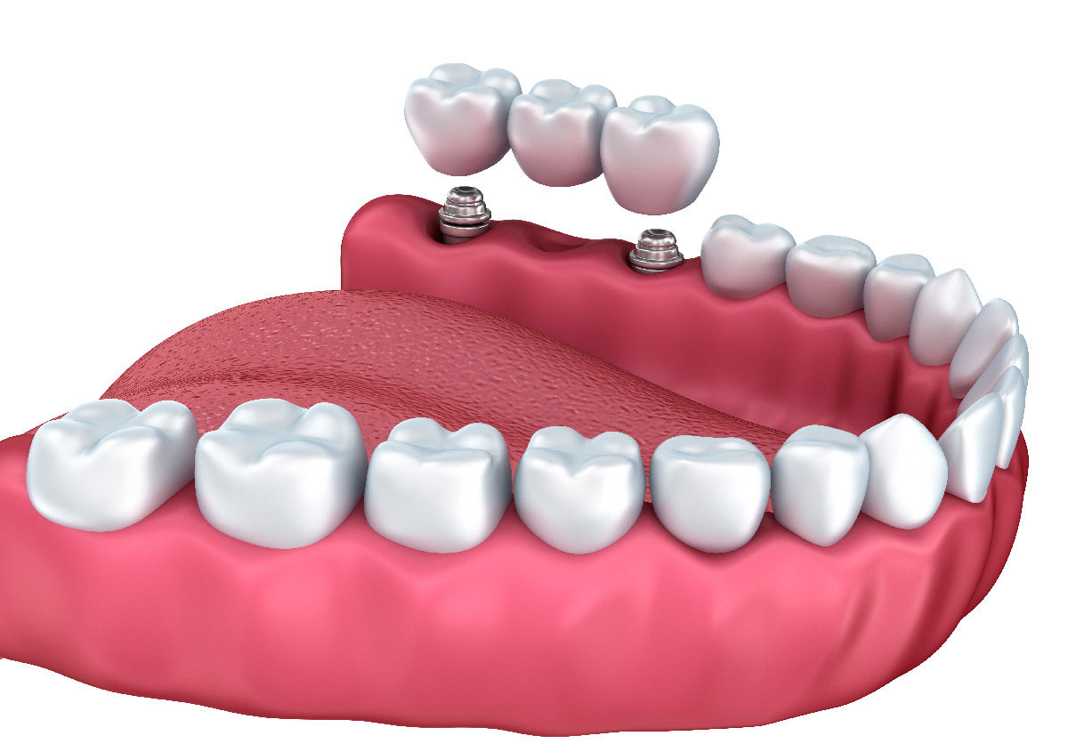 A Dental Implants Dentist Can Replace Missing Teeth for a Lifetime