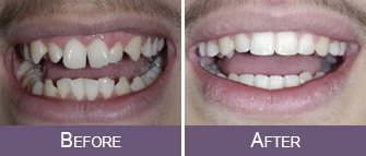 The Before and After results of Invisalign Treatment, Sacramento, CA