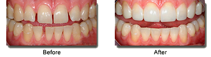 The Before and After results of Teeth Bonding, Sacramento, CA